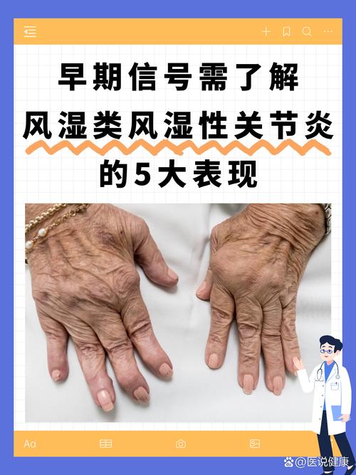 类风湿性关节炎症状最早表现为