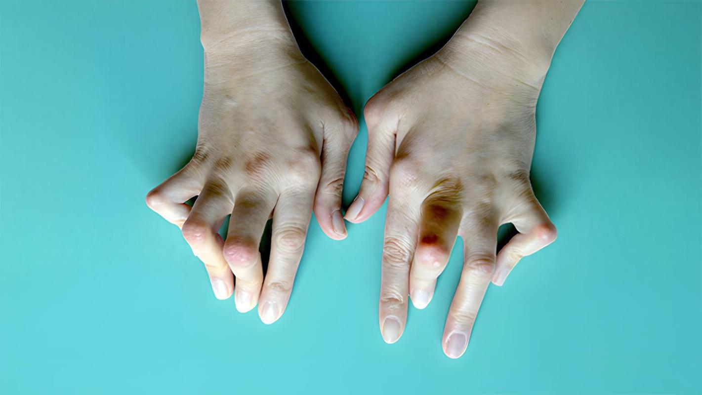 类风湿性关节炎 风湿性关节炎