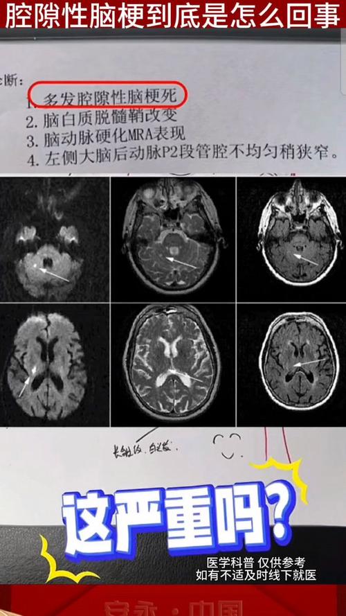 双侧基底节区腔梗灶是脑梗吗