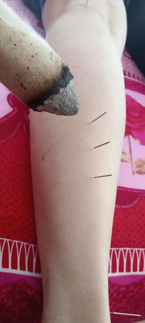 针灸治疗肩周炎特效穴位