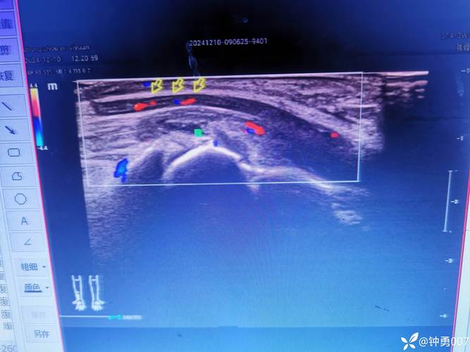 北京风湿类风湿挂号德胜门a