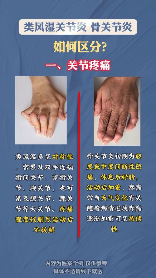 风湿关节炎 类风湿性关节炎