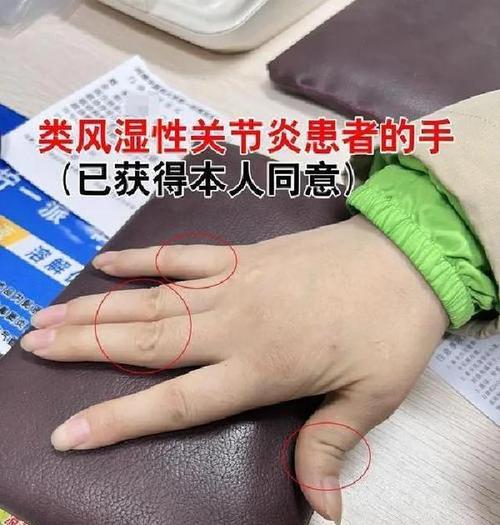 类风湿性关节炎的症状及治疗