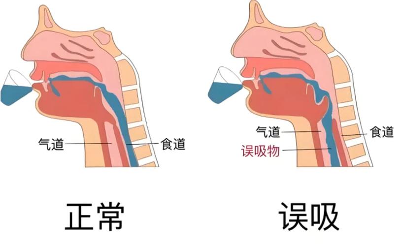 脑梗 吞咽功能哪个部位