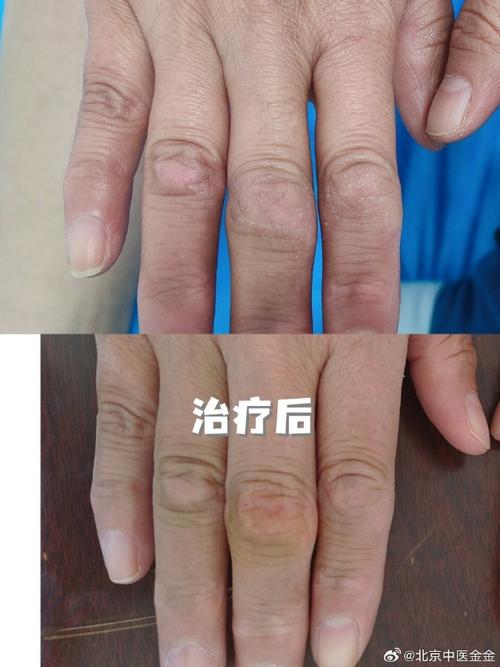 手指风湿性关节炎的早期症状