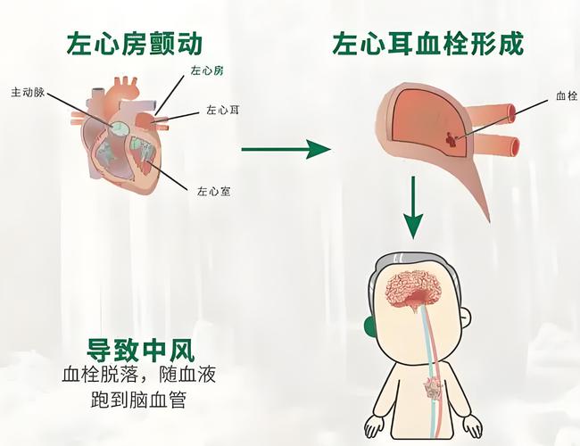 高血压 房颤 轻度脑梗