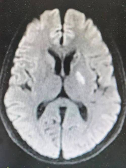 ct未见明显异常 脑梗
