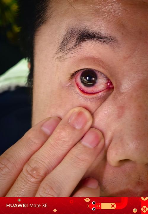 脑梗 瞳孔光线 没反应