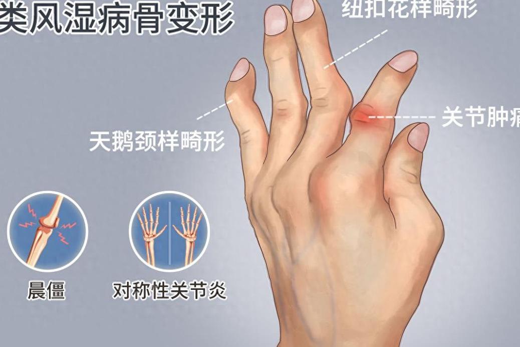 类风湿手指变形矫正手术费用