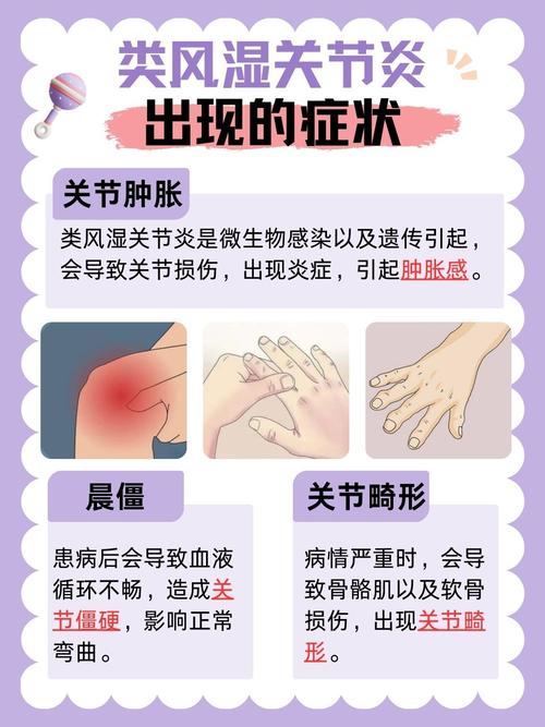 类风湿性关节炎的症状是什么