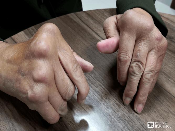 类风湿性关节炎的症状是什么