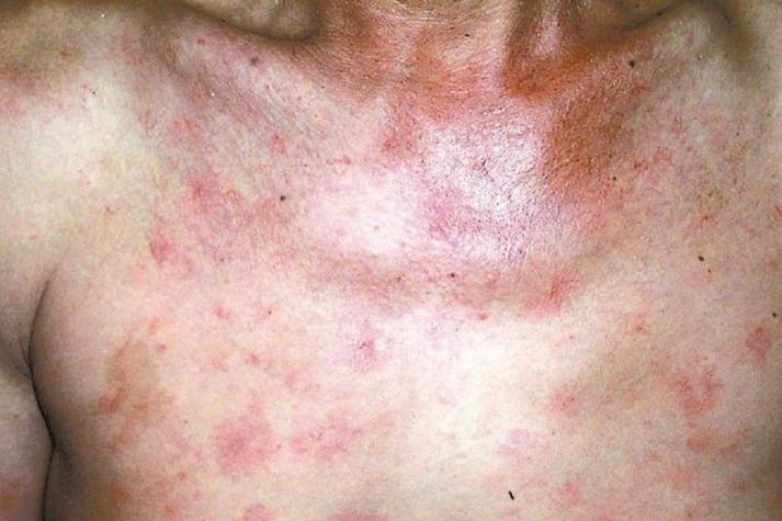 风湿类风湿会引起蜘蛛痣吗