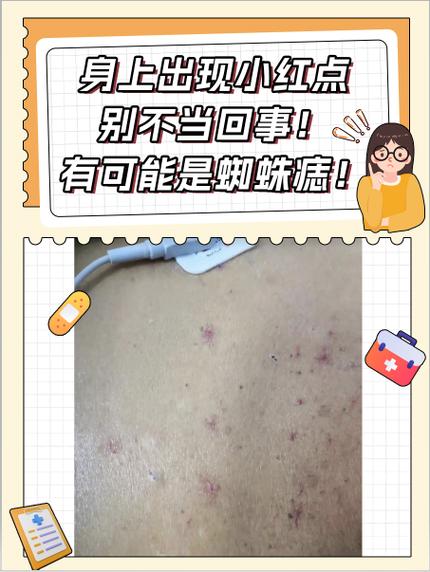 风湿类风湿会引起蜘蛛痣吗