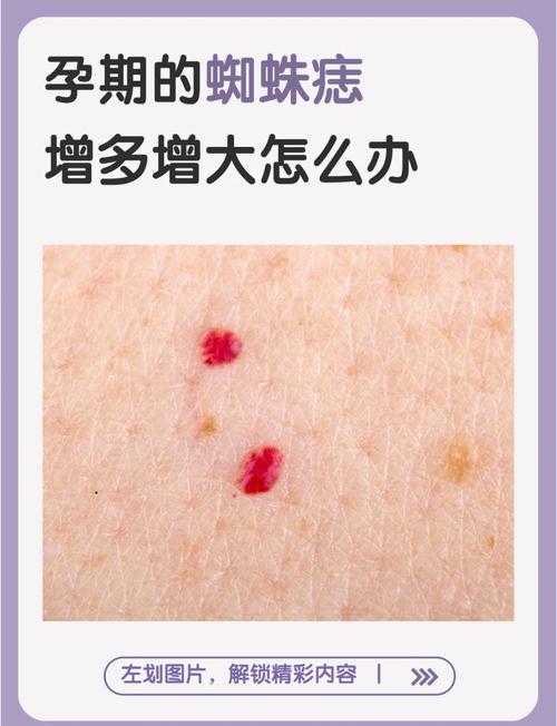 风湿类风湿会引起蜘蛛痣吗