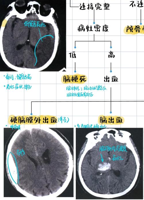 做脑ct正常会有脑梗吗
