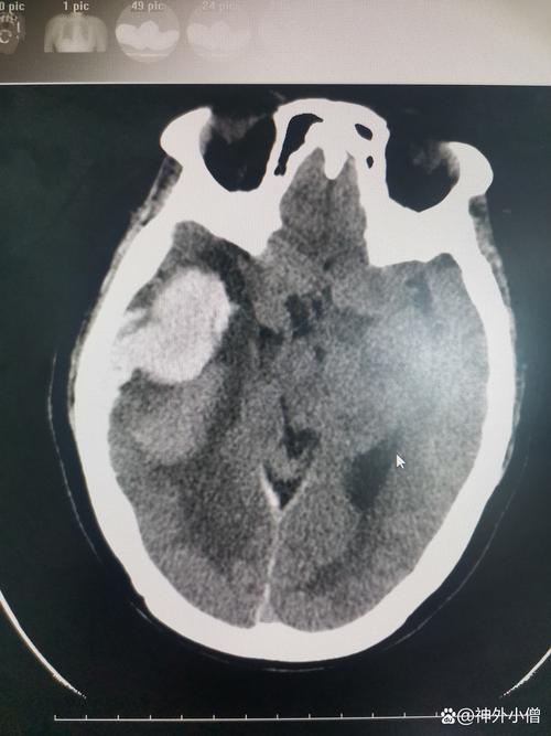 脑梗13天脑CT半暗带