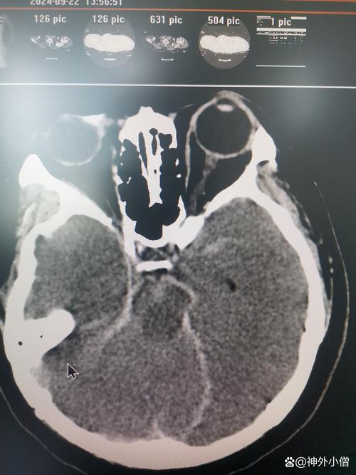 脑梗13天脑CT半暗带