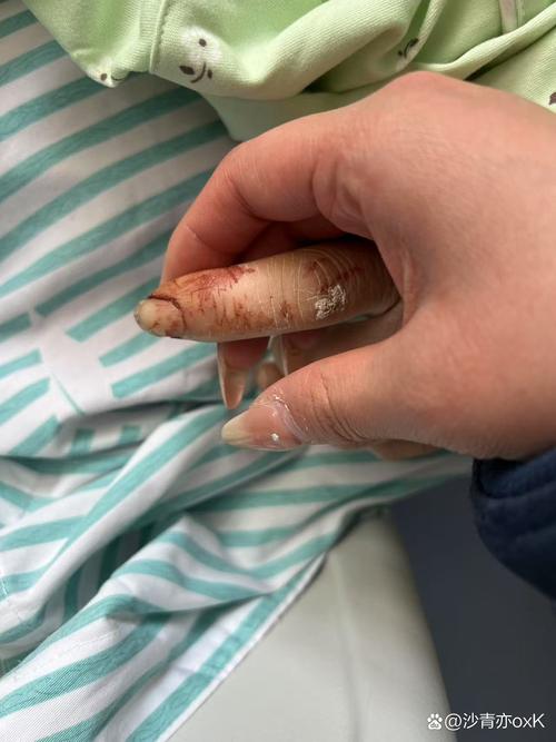 心梗和脑梗病人皮肤出血