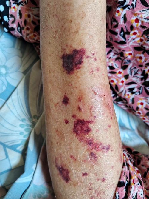 心梗和脑梗病人皮肤出血