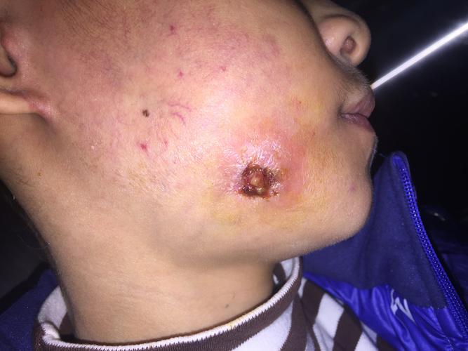 心梗和脑梗病人皮肤出血