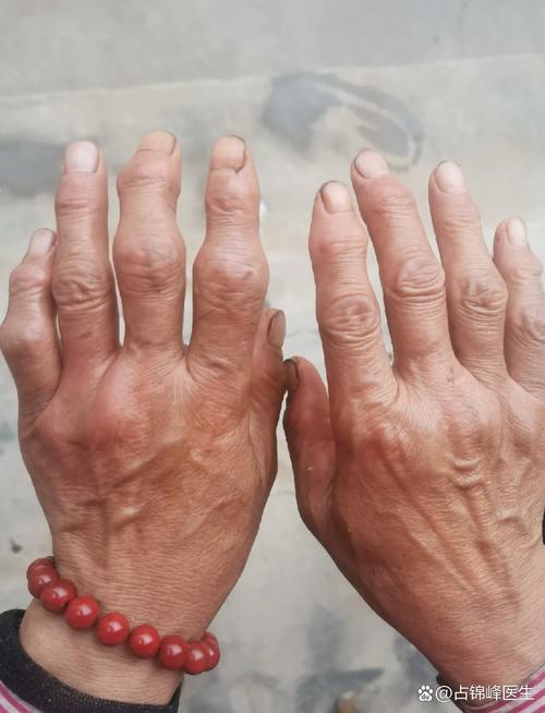 风湿和类风湿的症状是什么