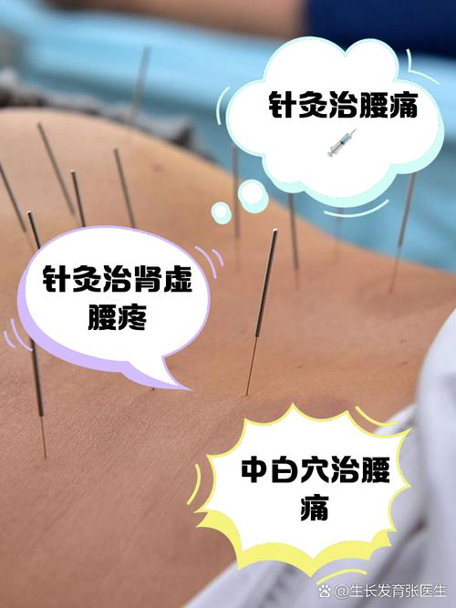 腰椎间盘突出症针灸穴位