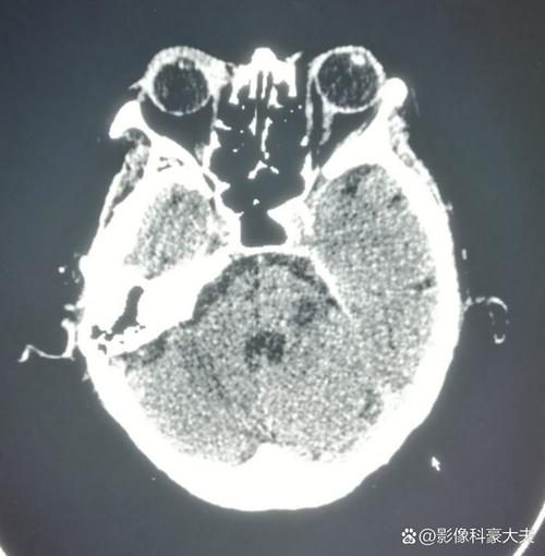 只做脑ct能查出脑梗吗