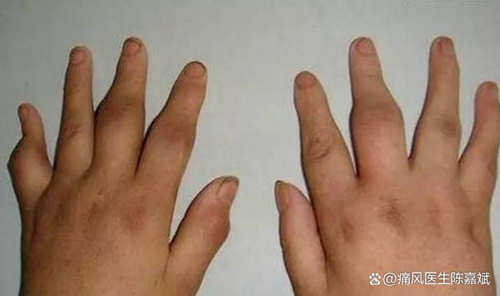 类风湿病的类风湿因子高