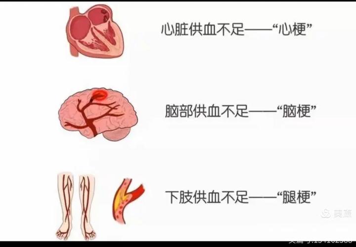 心梗脑梗好发于早上5点