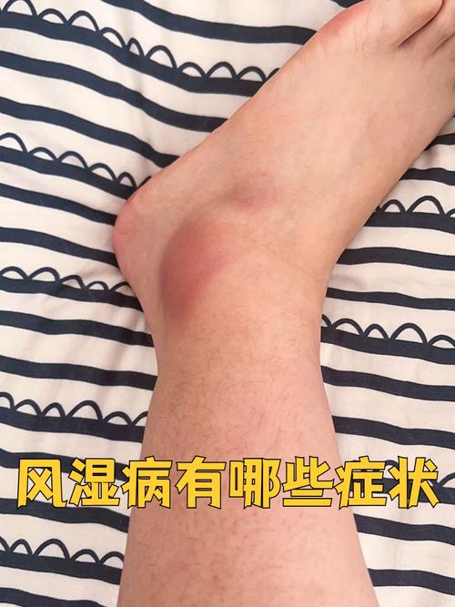 风湿热风湿病是什么症状