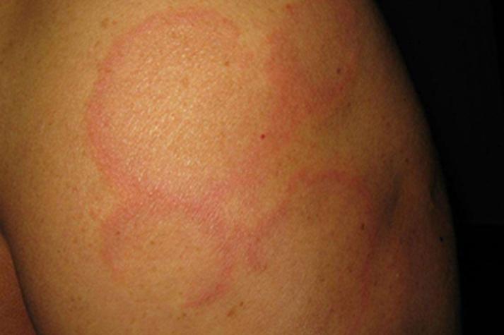 风湿热风湿病是什么症状