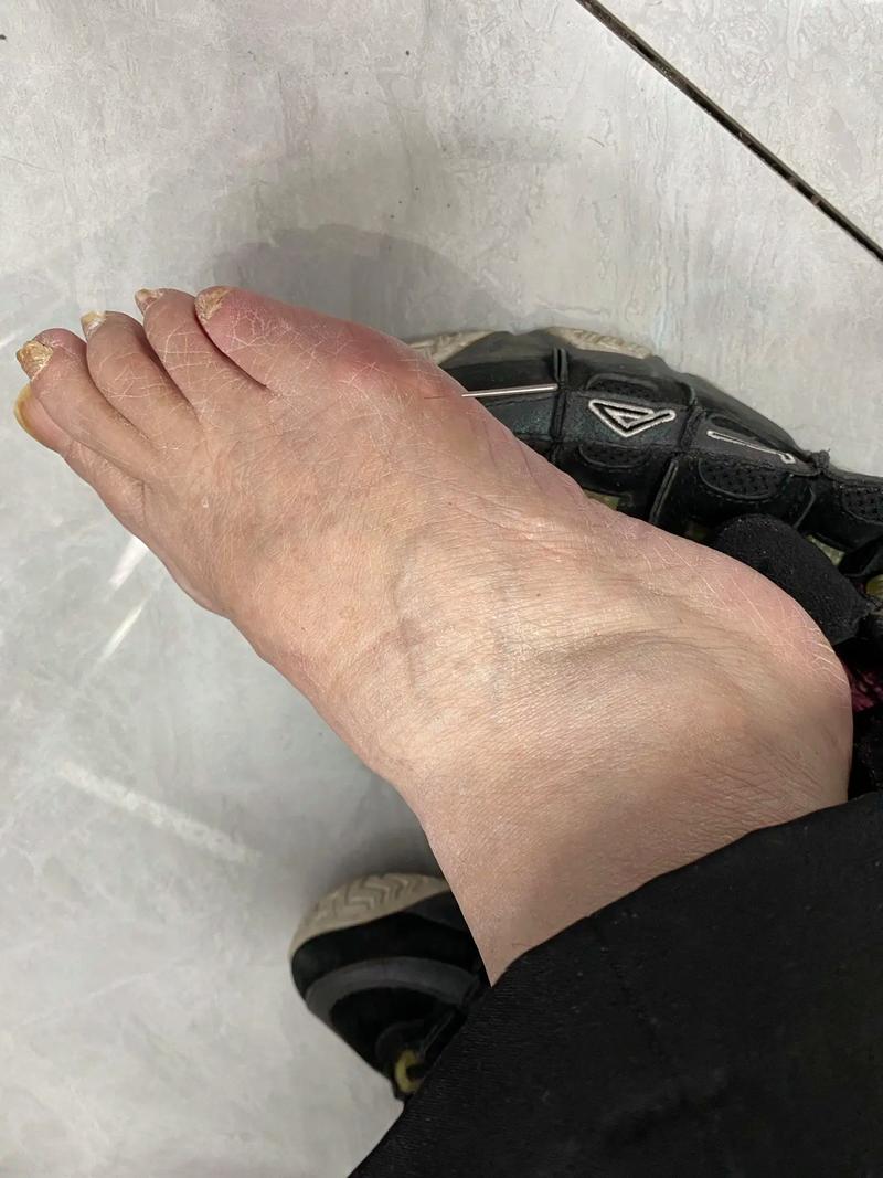 风湿痛吗可以打风湿针吗