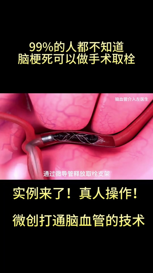 脑梗脑动脉粥样硬化治疗