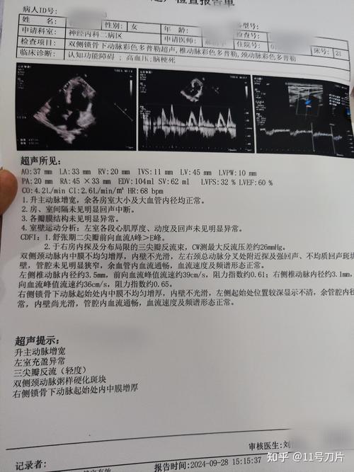 脑血流图能检查出脑梗么