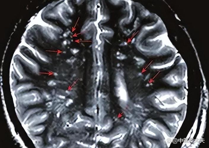 脑核磁 缺血灶和脑腔梗