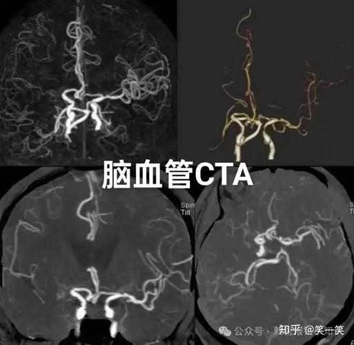 脑CTA能查出来脑梗吗