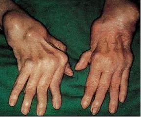 类风湿关节炎类风湿结节