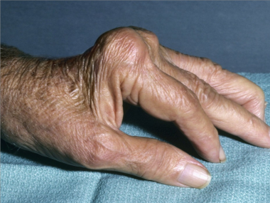 类风湿关节炎类风湿结节