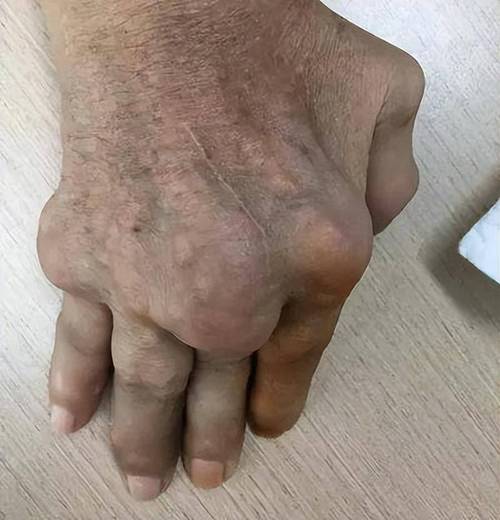 类风湿关节炎类风湿结节