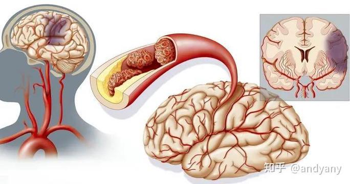 脑主干脑梗租打嗝怎么办