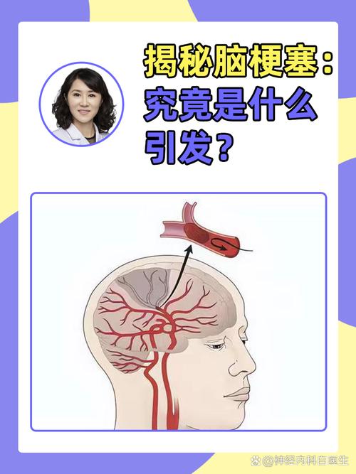 没有脑动脉硬化会脑梗吗