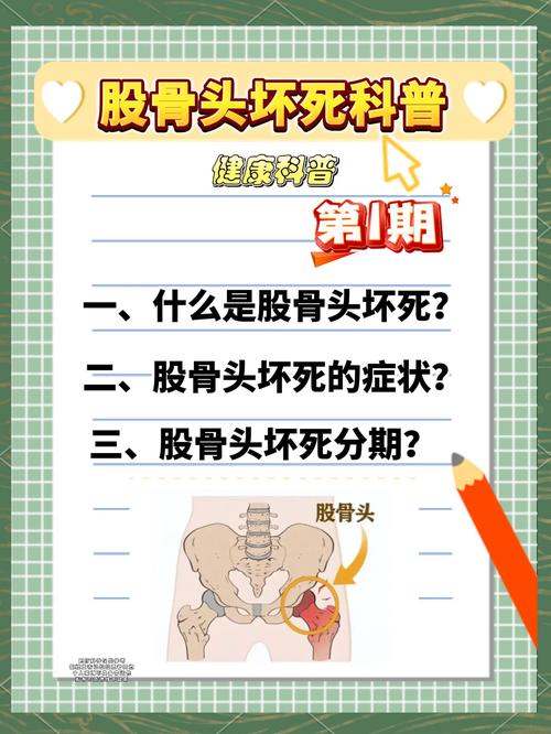 风湿类风湿与股骨头坏死