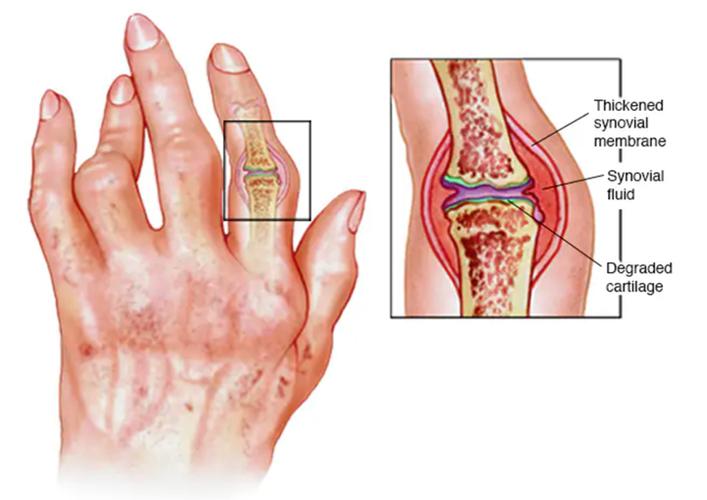风湿性多肌疼转成类风湿