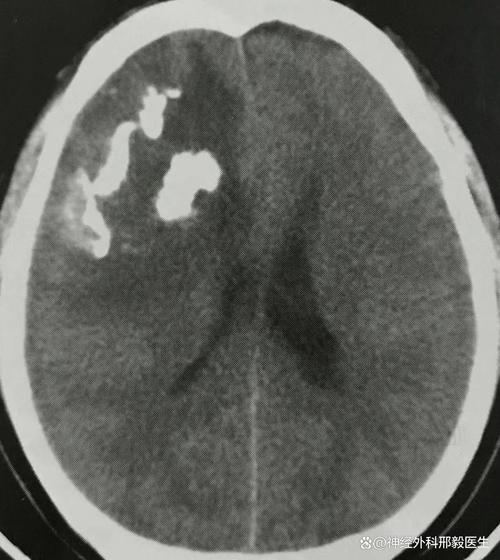 65岁头疼脑梗脑胶质瘤