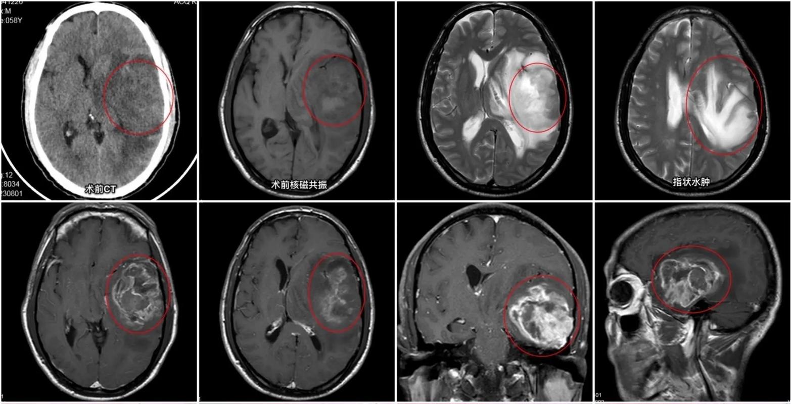 65岁头疼脑梗脑胶质瘤