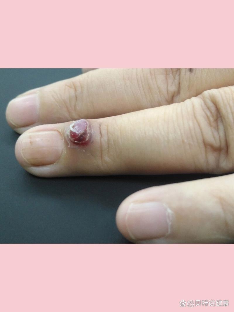 风湿性肉芽肿和风湿小体