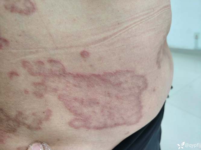 风湿性肉芽肿和风湿小体