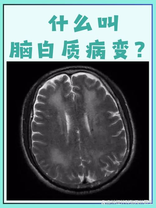 脑白质脱随乔贫血性脑梗