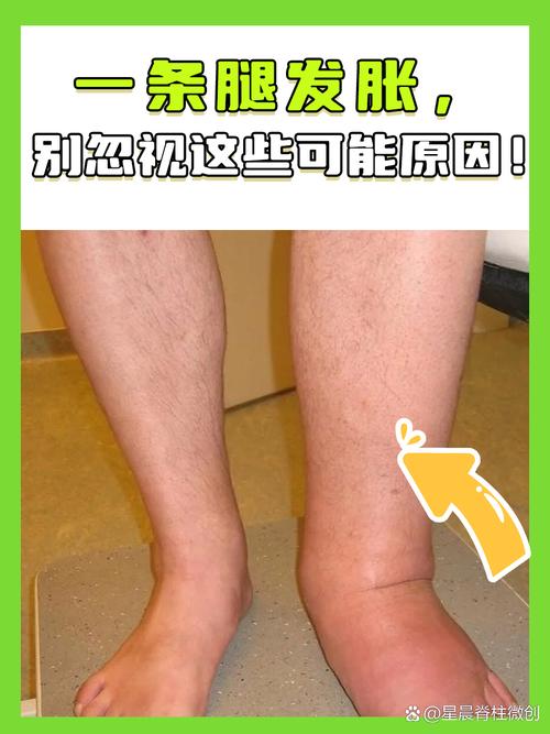 一条腿疼是风湿类风湿吗