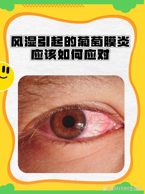 与风湿病相关的风湿眼病